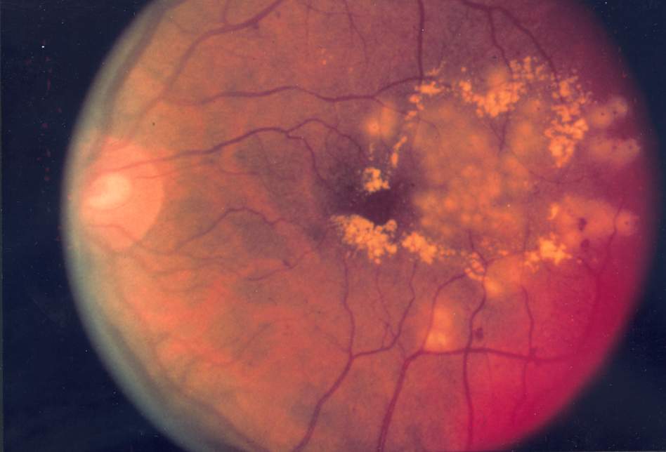 Fundus photograph showing focal laser treatment for diabetic retinopathy.