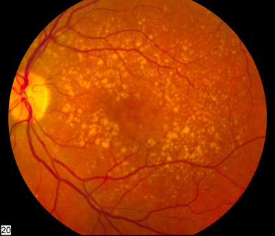 Fundus photograph showing intermediate age-related macular degeneration.