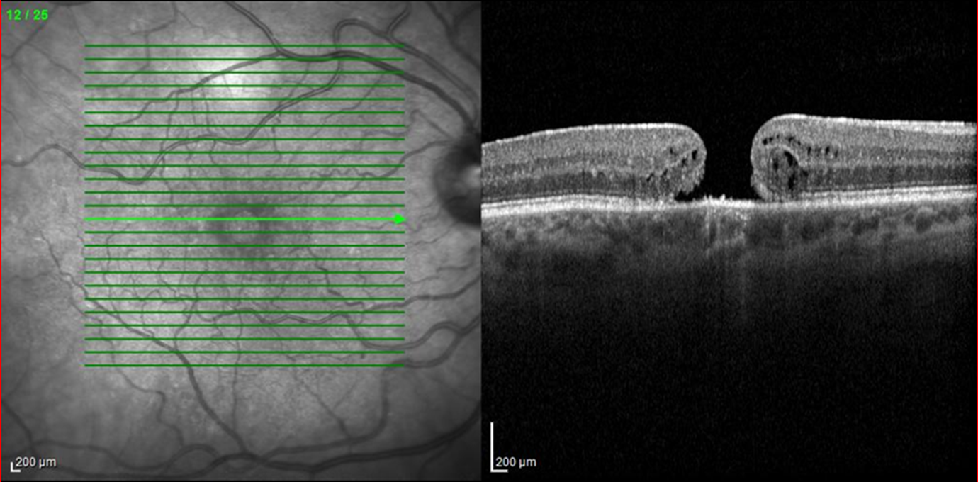 OCT image of a small macular hole.