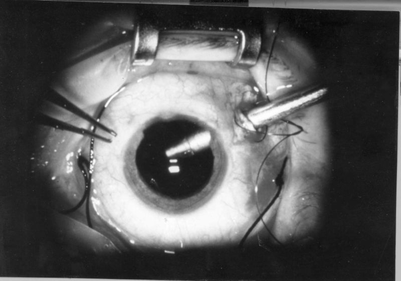 Vitrectomy surgery photograph.