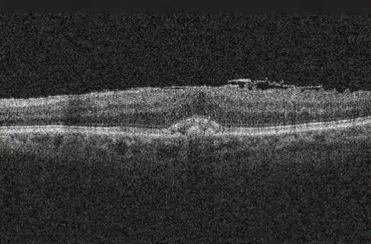 Optical coherence tomography image of epiretinal membrane and vitreomacular traction.