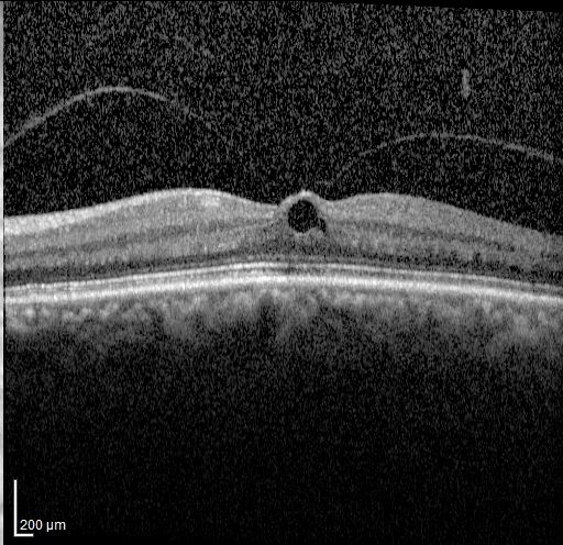 Optical coherence tomography image of a macular hole.