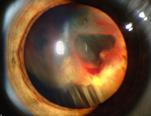 Retinal detachment clinical photograph.