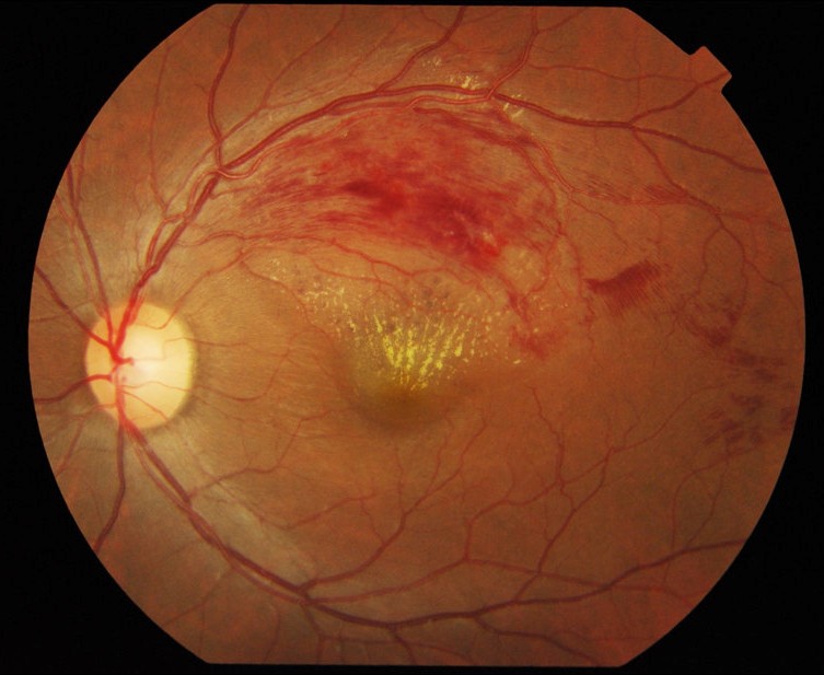 Fundus photograph of branch retinal vein occlusion.